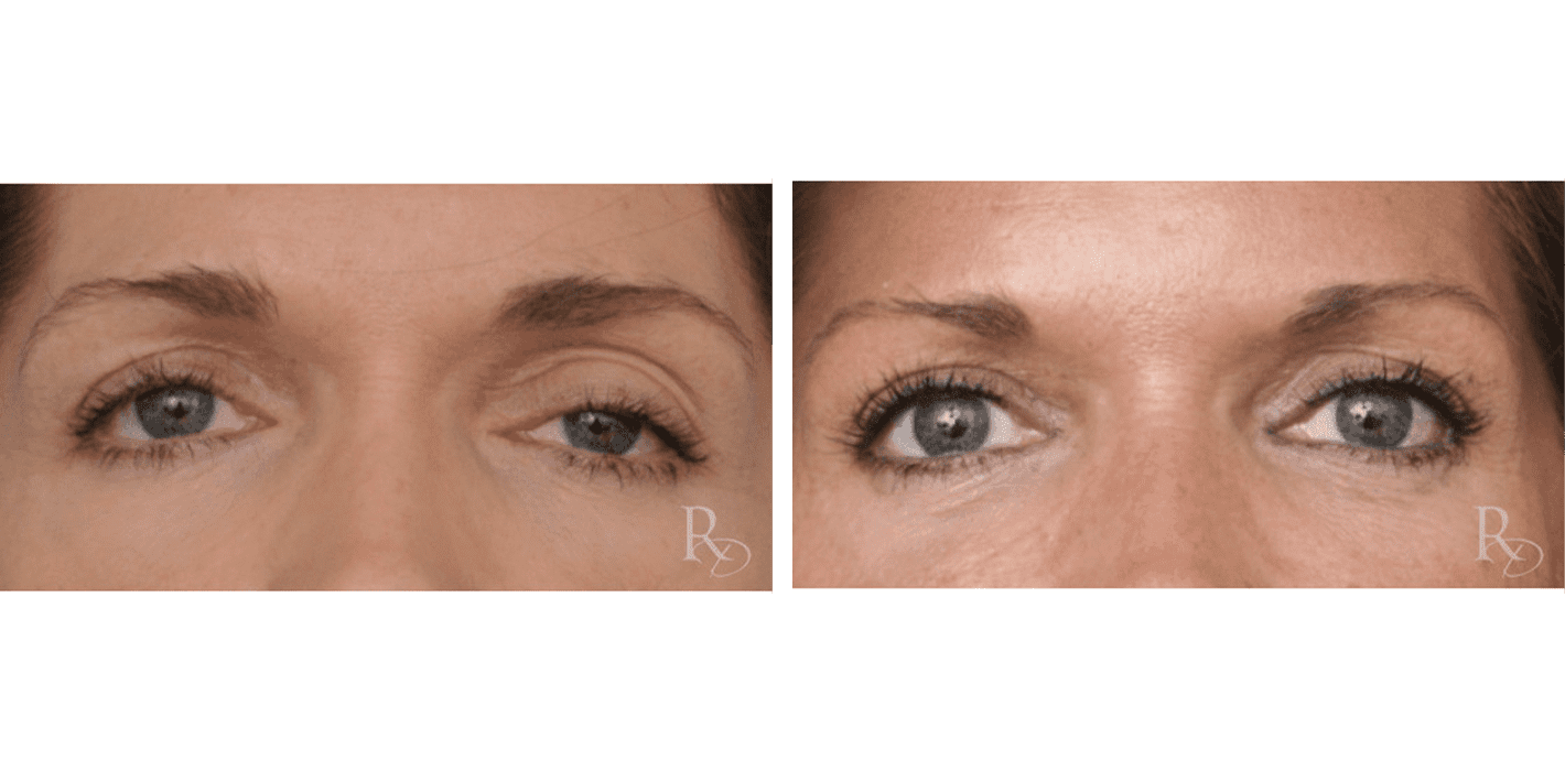 Upper Blepharoplasty with Ptosis Repair