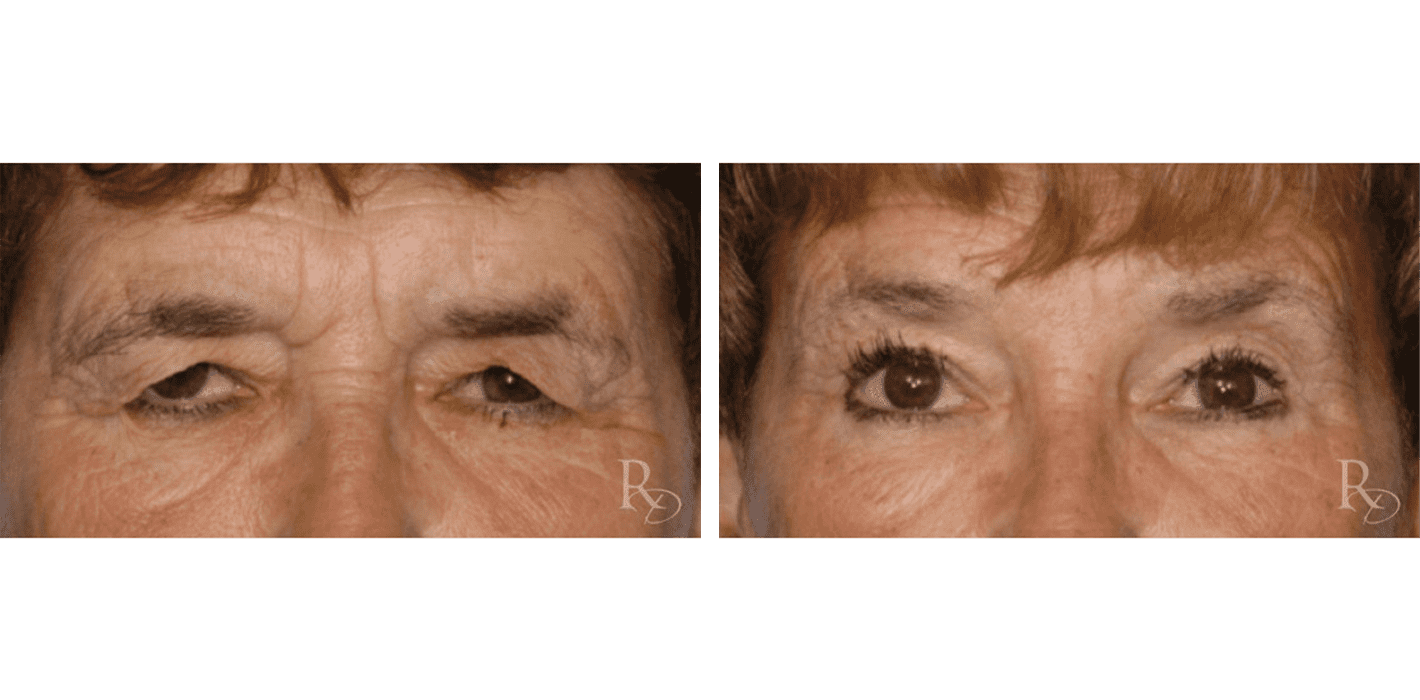 Upper Eyelid Rejuvenation