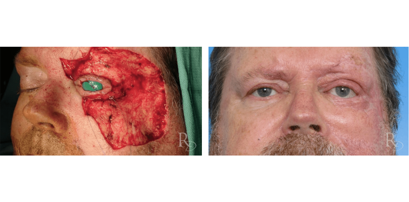 Before & After – Cancer Surgery