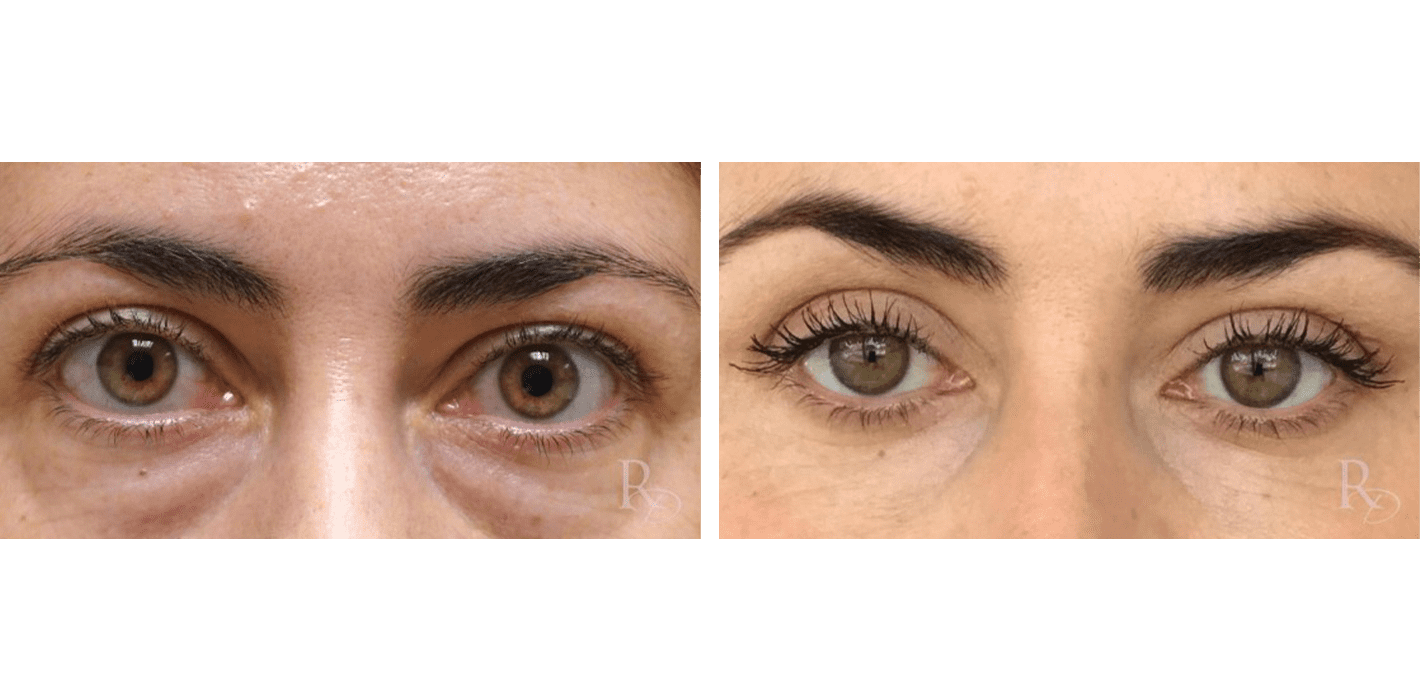 Prominent Eyes and Eyelid Revision