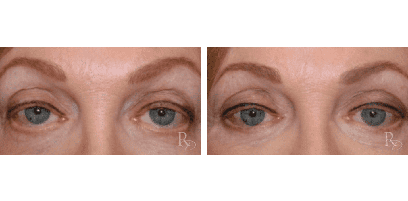 Prominent Eyes with Eyelid Retraction Repair