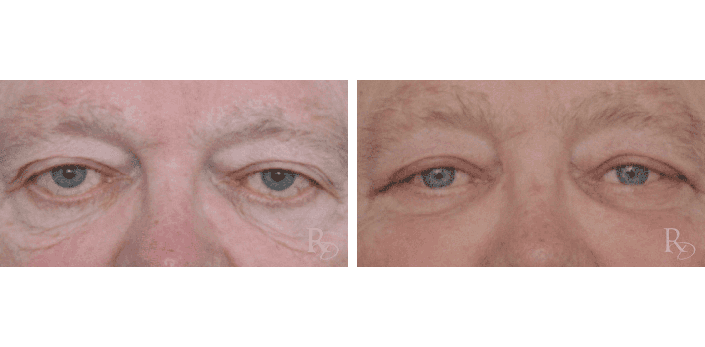 Prominent Eyes with Male Eyelid Revision Surgery