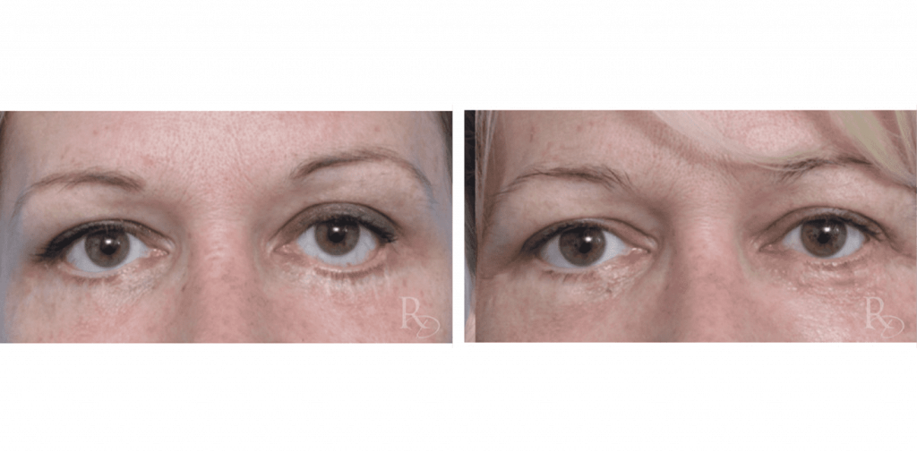 Before & After Eyelid Revision Surgery Raymond Douglas