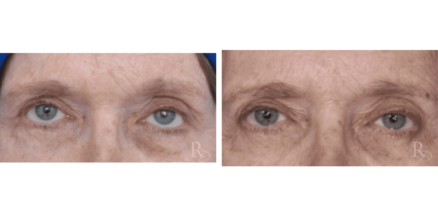 Non-Surgical Eyelid Revision