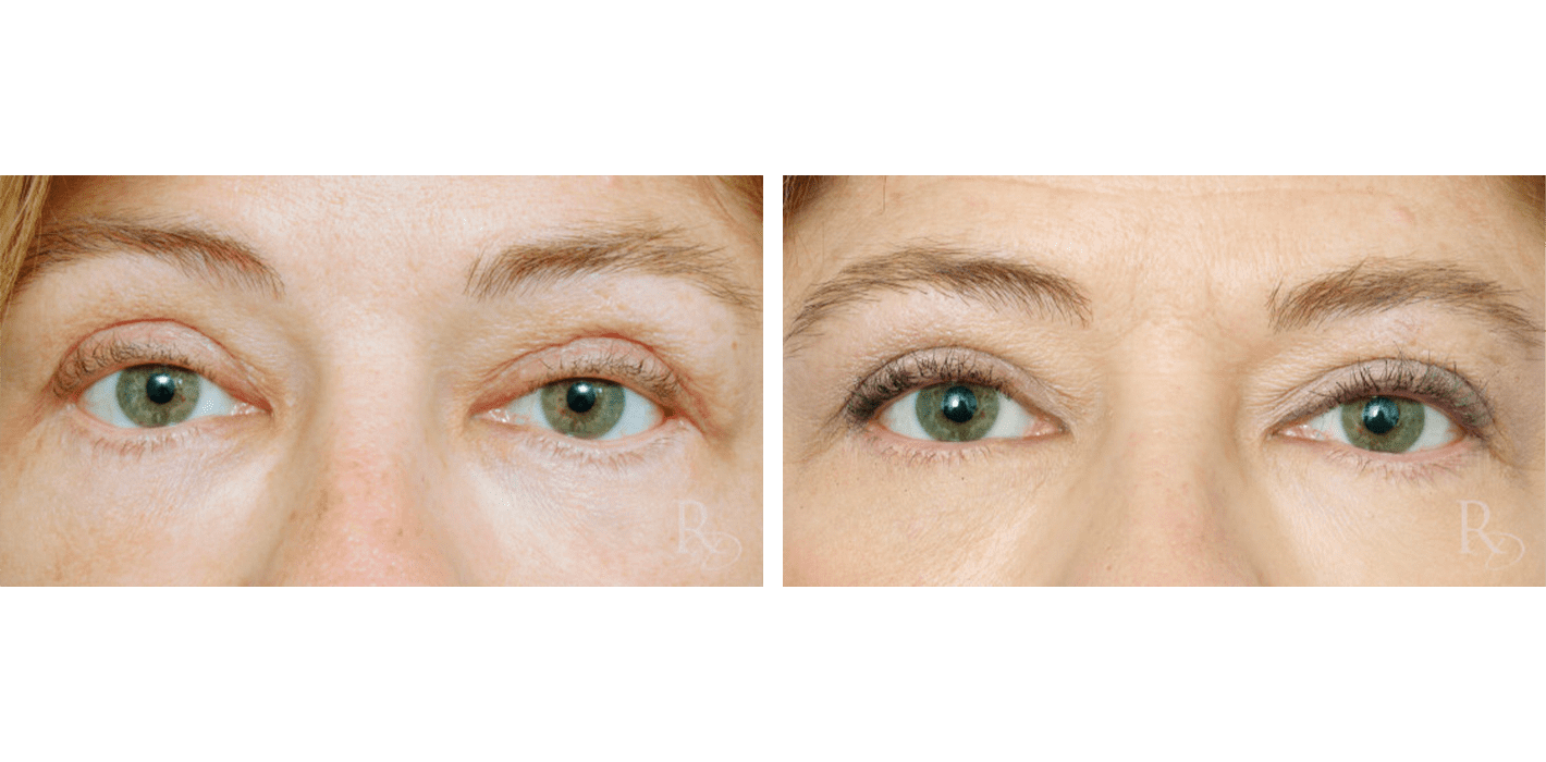 Eyelid Revision Surgery