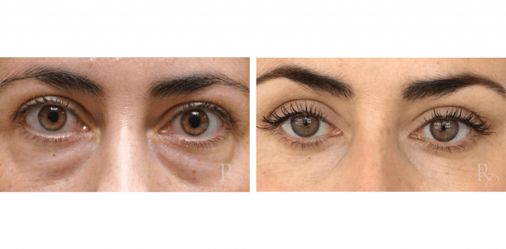 Eye Bulging Before & After Transformations Raymond Douglas