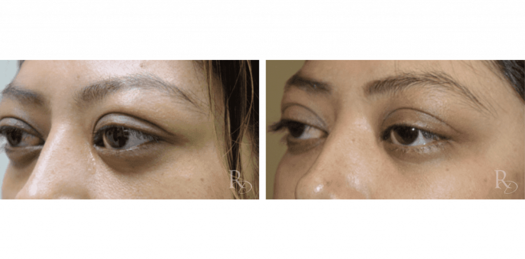 Eye Bulging Before & After Transformations Raymond Douglas