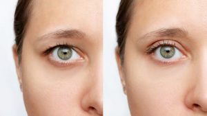 Foto del antes y el después de una mujer tras una blefaroplastia.