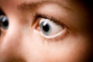 Una mujer con enfermedad ocular tiroidea mirando hacia otro lado.