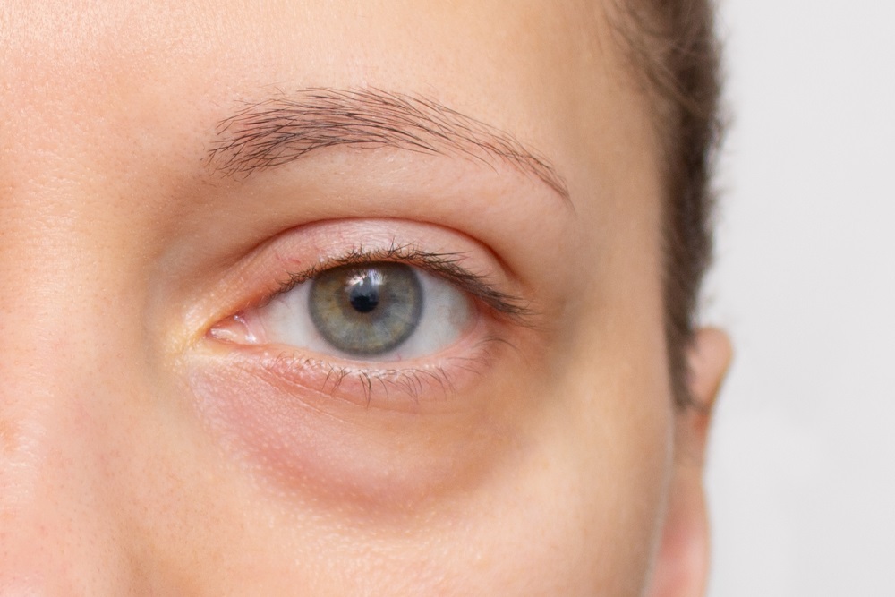 ¿Son las ojeras un signo de problemas tiroideos?