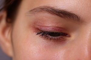 How Proptosis Affects Eyelid Closure and Corneal Health
